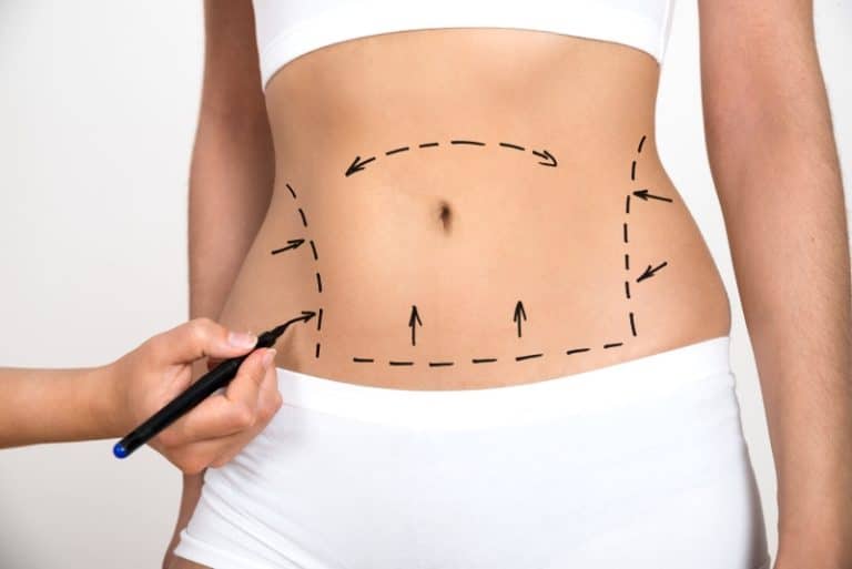 Operaciones de abdominoplastia con IM Clinic